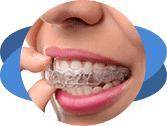 יישור שיניים בקשתיות שקופות (invisalign)