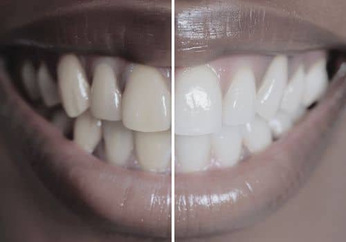 הלבנת שיניים - דר עומר פלייסיג
