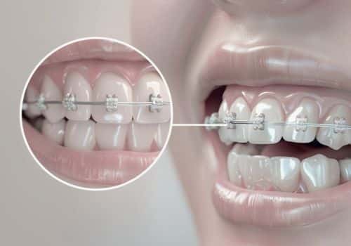 יישור שיניים אורתוגנטי - דר עומר פלייסיג