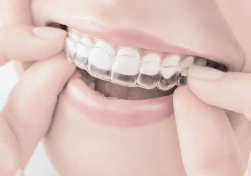 יישור שיניים בקשתיות שקופות אינויזליין Invisalign - רופא שיניים עומר פלייסיג