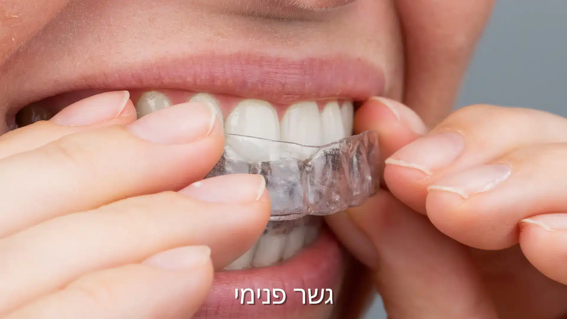 גשר פנימי - דוקטור עומר פלייסיג