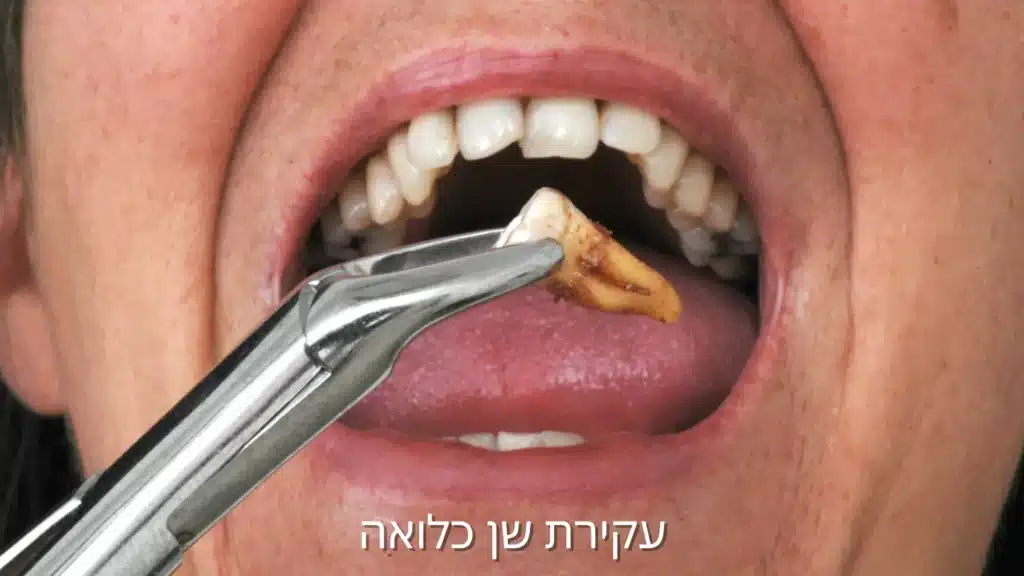 עקירת שן כלואה - דר עומר פלייסיג