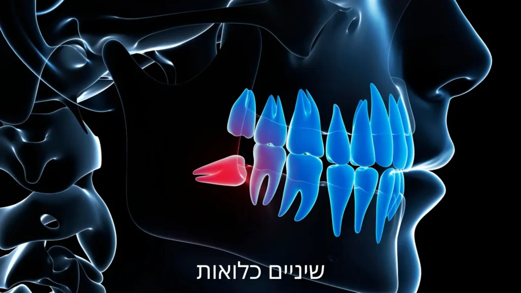 שיניים כלואות - דר עומר פלייסיג