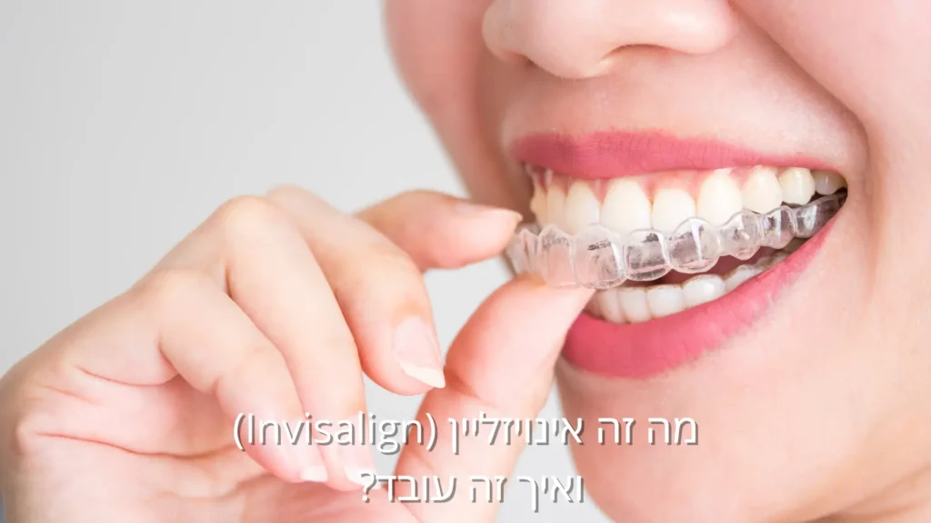 אינויזליין Invisalign – קשתית שקופה ליישור שיניים באופן נוח ואסתטי
