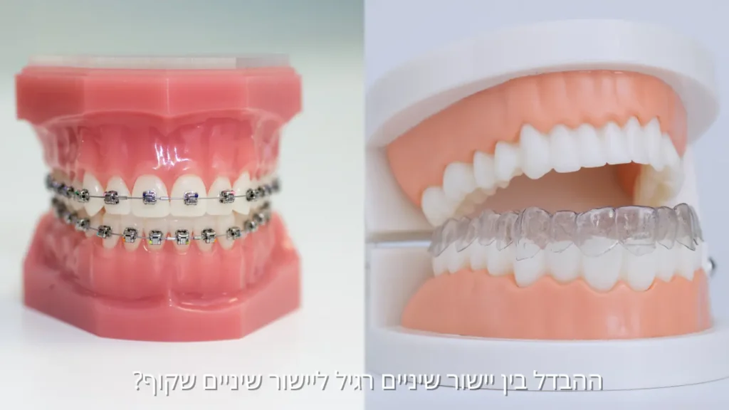 גשר מתכתי מול קשתיות שקופות – ההבדלים העיקריים בטיפול