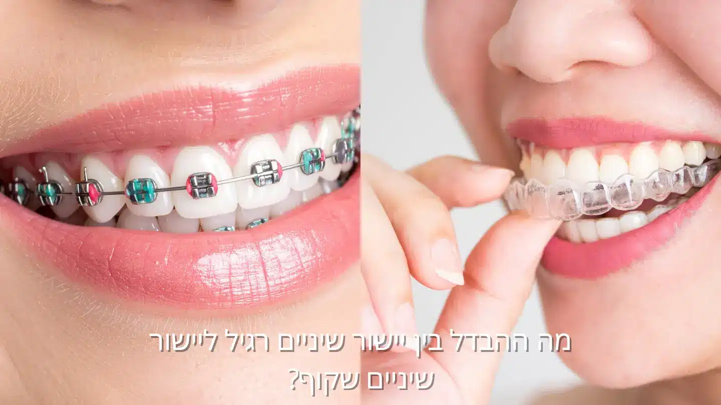 יישור שיניים רגיל מול יישור שקוף – איך זה נראה בפועל
