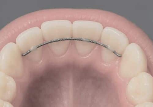 קיבוע בשיניים במרפאת דר עומר פלייסיג