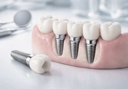 שיקום הפה - דר עומר פלייסיג