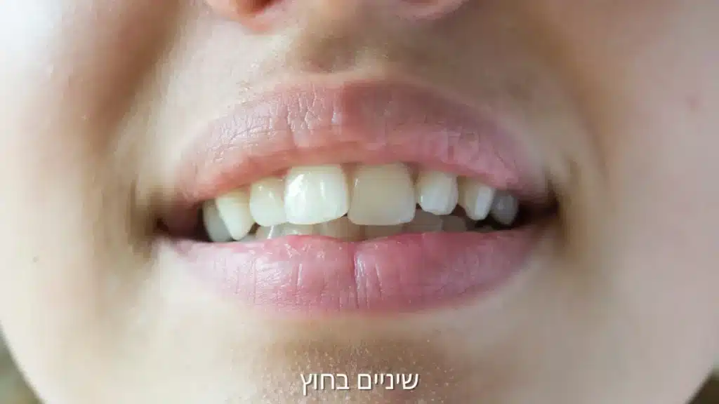 שיניים בחוץ לפני טיפול אורתודונטי