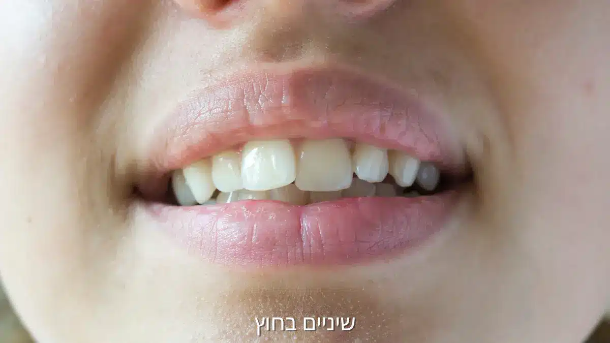 שיניים בחוץ לפני טיפול אורתודונטי
