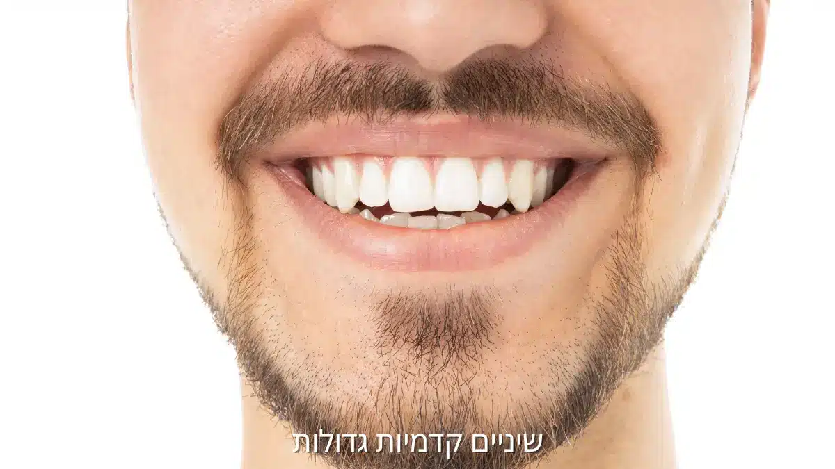 שיניים קדמיות גדולות והשפעתן על מראה החיוך