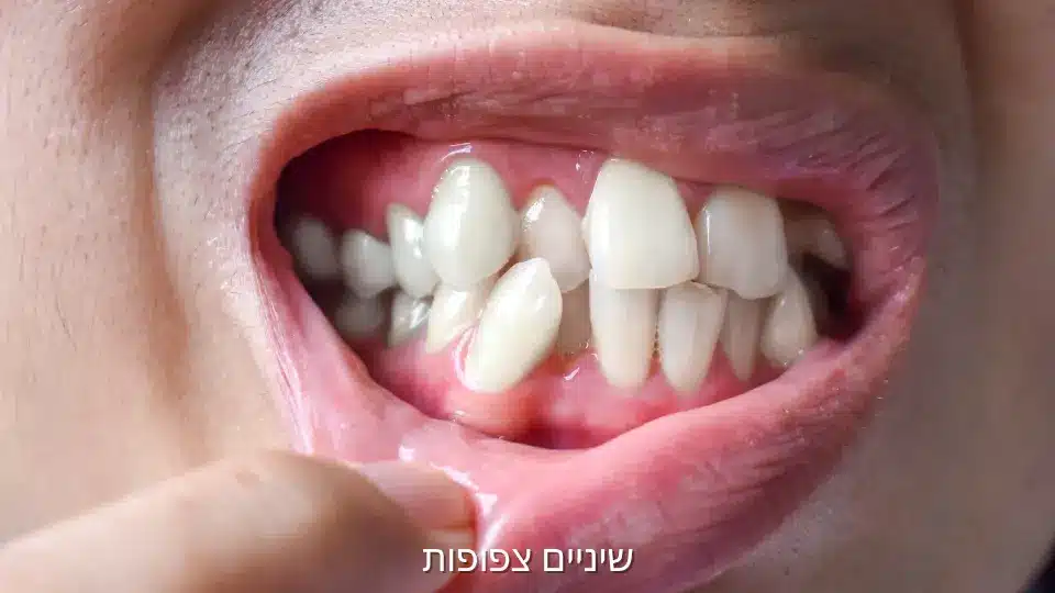 צפיפות שיניים וטיפול אורתודונטי