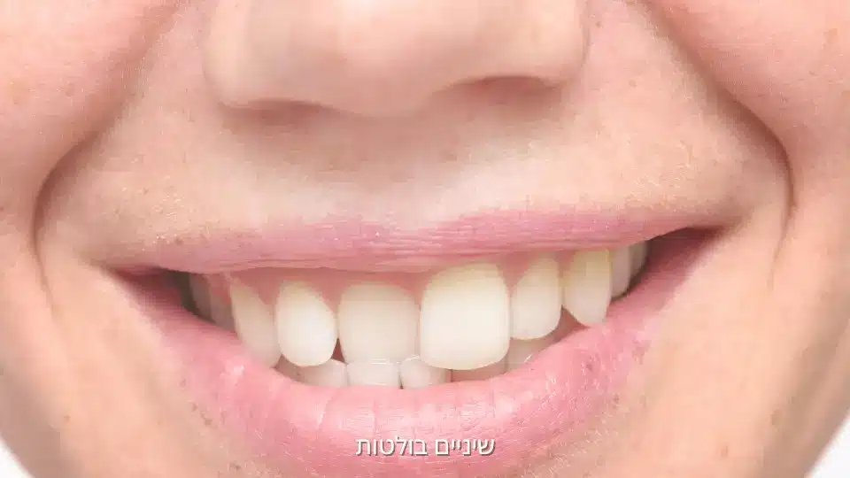 שיניים בולטות והשפעה על החיוך