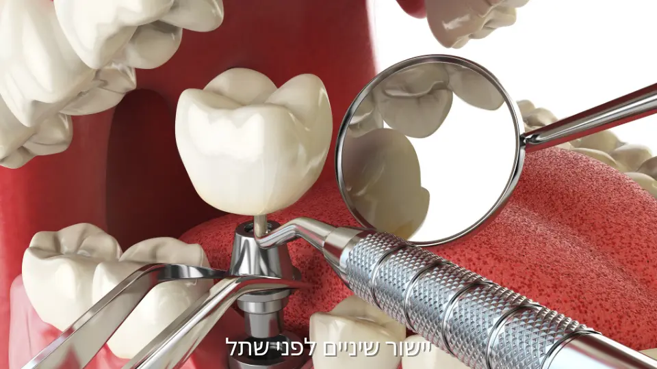 תכנון שתל דנטלי לאחר יישור שיניים